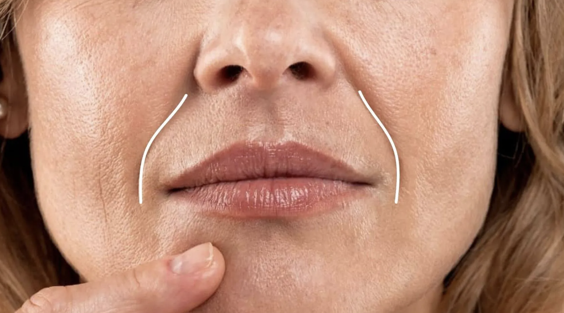 Как убрать носогубные складки: 3 домашних лайфхака