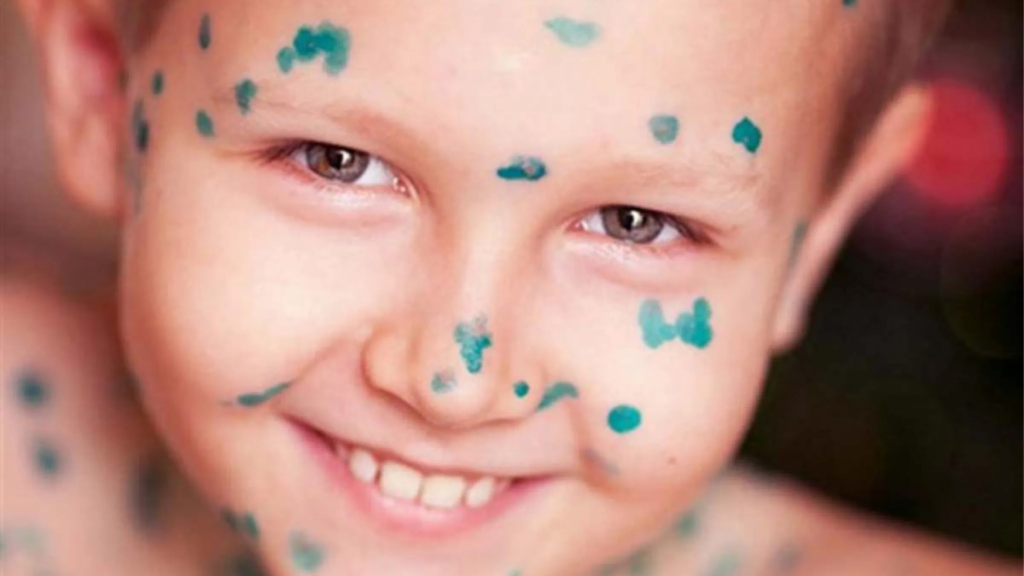 Як пережити вітрянку без шрамів і сліз: поради педіатра, які дійсно працюють