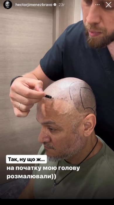 Ектор Хіменес-Браво зробив пересадку волосся і розповів, як минула його операція (ФОТО) - фото №1