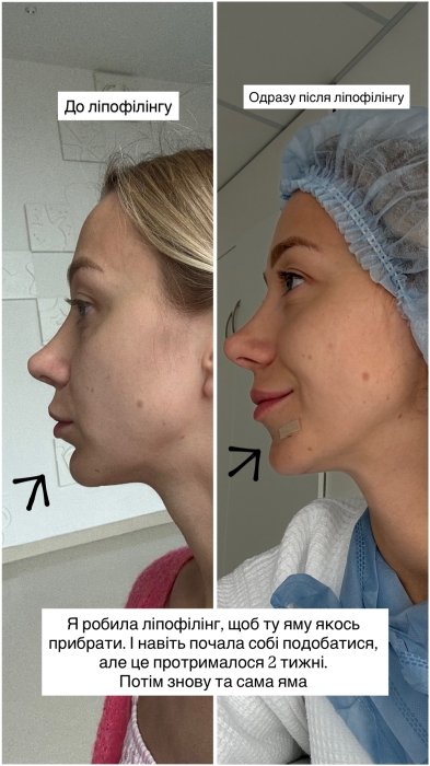 Катерина Репяхова показала результат “до” та “після”