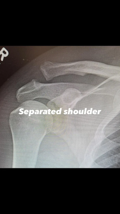 Ченнінга Татума прооперували, що відомо