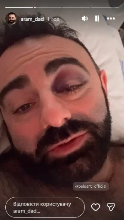 Арам Арзуманян показал свое состояние после падения в оркестровую яму