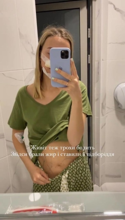 Катерина Репяхова показала результат пластичних операцій