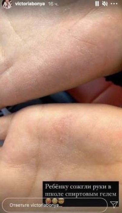 Дочь Виктории Бони Анджелина сожгла руки антисептиком - фото №2