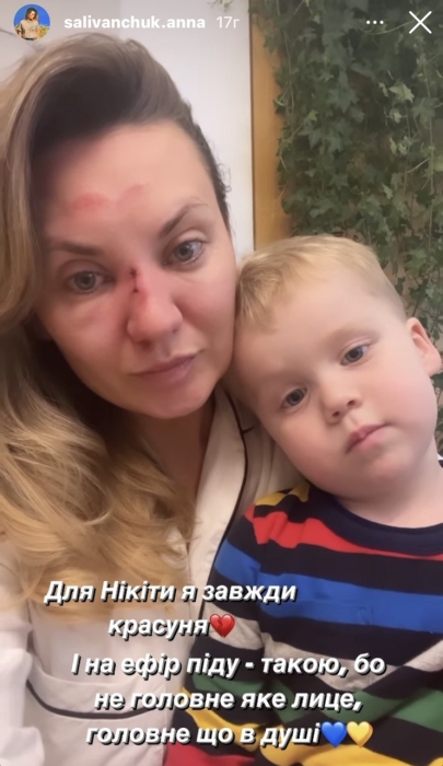 Анна Саливанчук шокировала кадрами со сломанным носом: "Похожа на аваторов" - фото №1