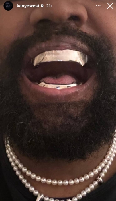 Канье Вест витратив $850 тисяч, аби позбутися зубів. Тепер в його роті смак протезів, дорожчих за діаманти (ФОТО) - фото №1
