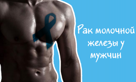 Рак молочной железы у мужчин: особенности редкого заболевания