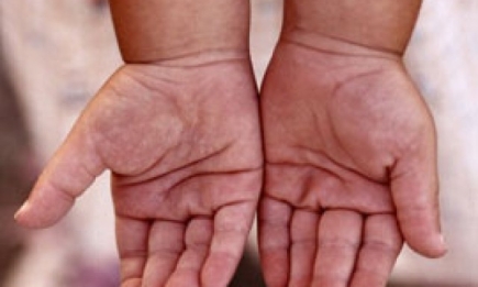 Длина пальцев рук расскажет о возможных болезнях