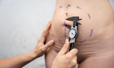 Не замість дієти, а для ідеального контуру: все, що ви хотіли знати про ліпосакцію