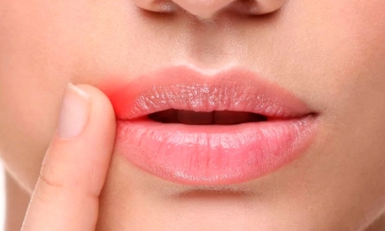 Как быстро вылечить заеды в уголках рта: эффективные способы