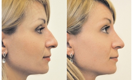 Исправь форму носа или все, что необходимо знать про ринопластику