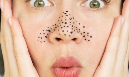 Как убрать черные точки на носу и сделать кожу в T-зоне идеальной? Ответ косметолога и опыт редакции