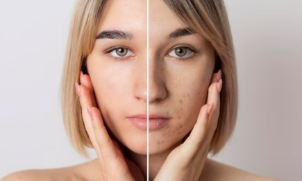 Прищі та місячні: експерт розповіла, як врятувати шкіру обличчя і виглядати приголомшливо