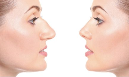 Які питання поставити пластичному хірургу: 10 кроків до ідеальної ринопластики