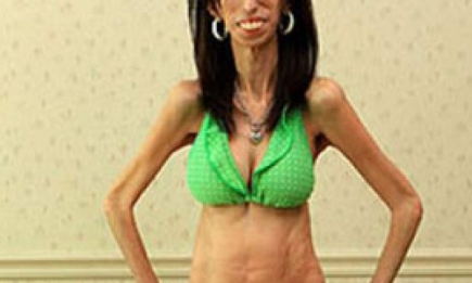 Ужасная болезнь Лиззи Веласкес: девушка ест 60 раз в день, а весит 25 кг!
