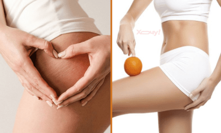 Целлюлит, прощай! 4 секрета, которые вернут красоту и здоровье вашей кожи — в домашних условиях