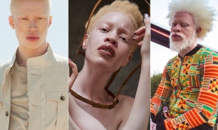 Международный день распространения информации об альбинизме: известные люди, доказавшие, что альбинизм — это уникальность