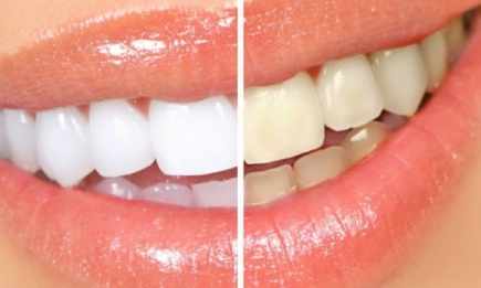 Топ 10 способов отбелить зубы в домашних условиях