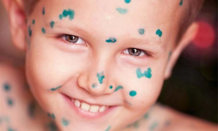 Як пережити вітрянку без шрамів і сліз: поради педіатра, які дійсно працюють