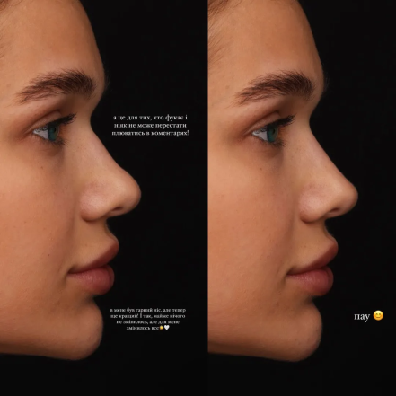 Саша Бо ринопластика, фото