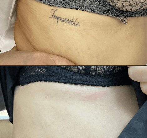 Лазерне видалення тату плюси, мінуси та ціна