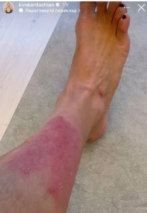 "Не буду брехати, це боляче": Кім Кардаш'ян показала, що сталося з її шкірою після чергового спалаху псоріазу (ФОТО) - фото №2