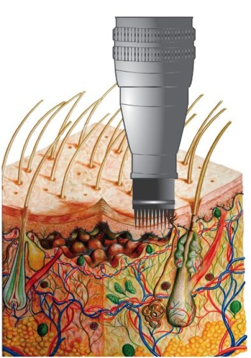 Чем опасен микронидлинг