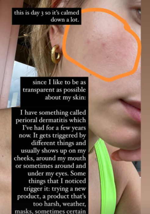 Звездный опыт: Хейли Бибер рассказала, как она ухаживает за проблемной кожей - фото №2