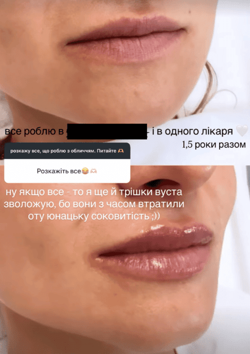 Ольга Мартиновська розповіла про косметологічні процедури