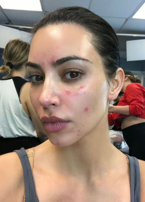 "Не буду брехати, це боляче": Кім Кардаш'ян показала, що сталося з її шкірою після чергового спалаху псоріазу (ФОТО) - фото №1