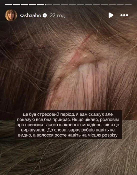 Саша Бо показала, як у неї випало волосся, фото