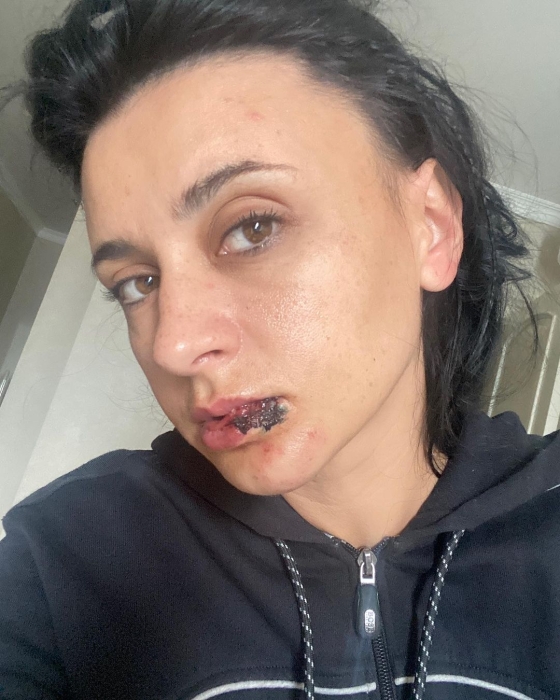 Певица NAVKA разбила лицо и выбила зуб на съемках мюзикла (ФОТО) - фото №2