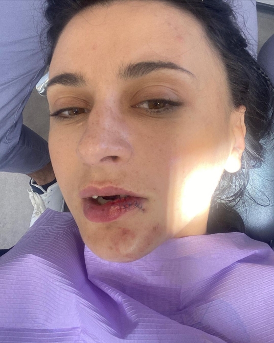 Певица NAVKA разбила лицо и выбила зуб на съемках мюзикла (ФОТО) - фото №1