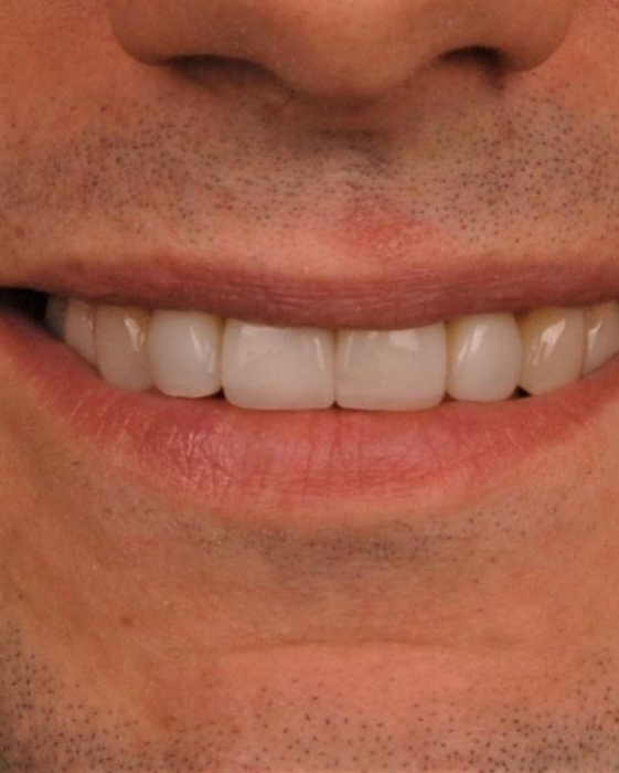 Голливудская улыбка: Александр Эллерт сделал "новые" зубы и показал результат - фото №3