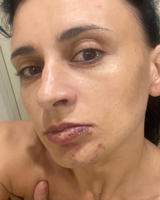 Певица NAVKA разбила лицо и выбила зуб на съемках мюзикла (ФОТО) - фото №3