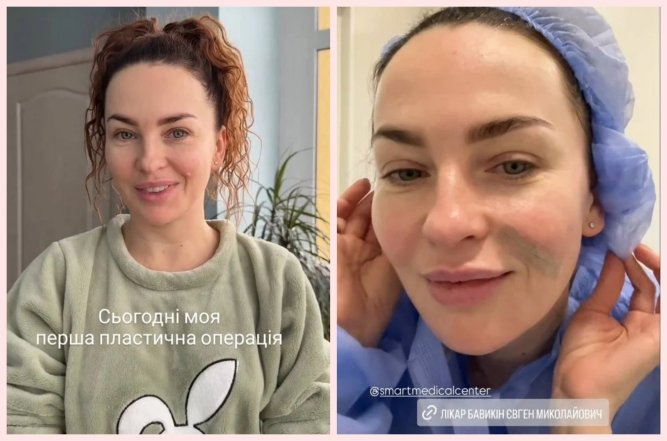 Виктория Булитко до и после пластики, фото