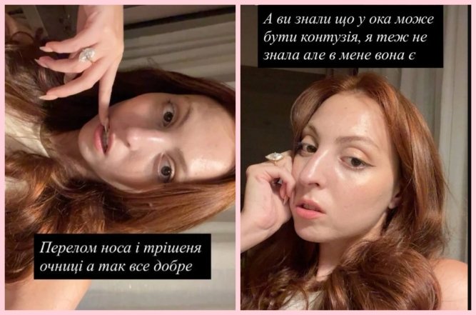 Как Маша Полякова выглядит после аварии, фоо