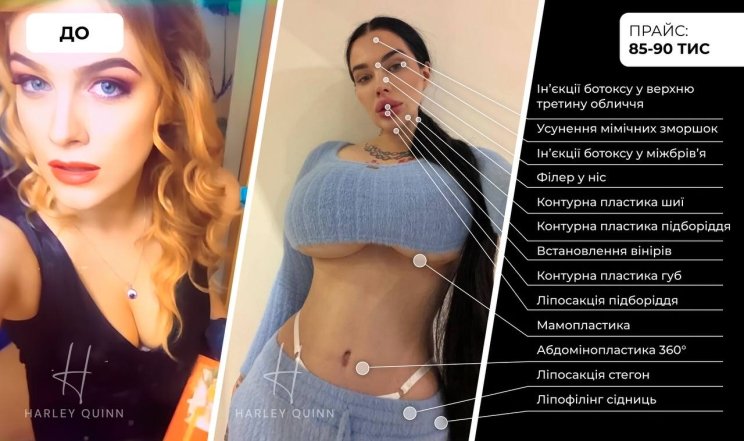 Марія Тиха пластичні операції, фото