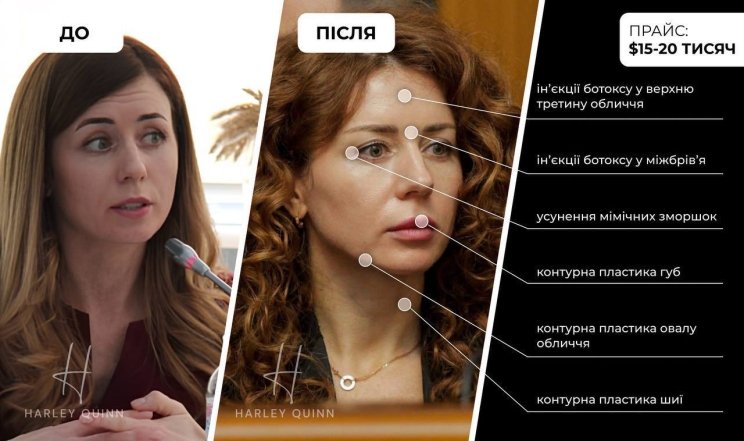 Світлана Гринчук до та після пластики