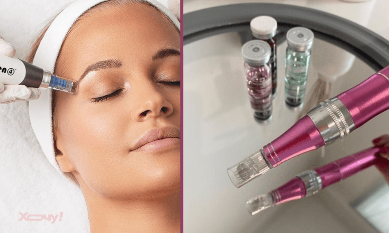 Что такое микронидлинг лица