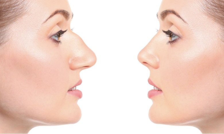 Пластичний хірург Дмитро Слоссер про ринопластику: що варто знати усім пацієнтам