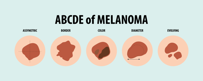 Як виглядає меланома - фото