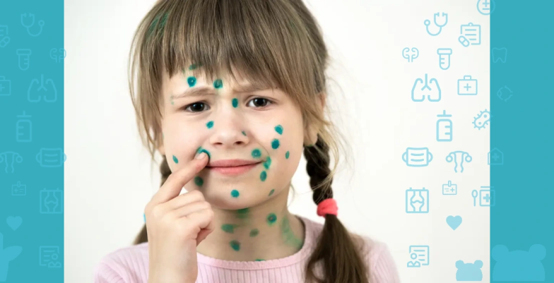 Як лікувати вітрянку